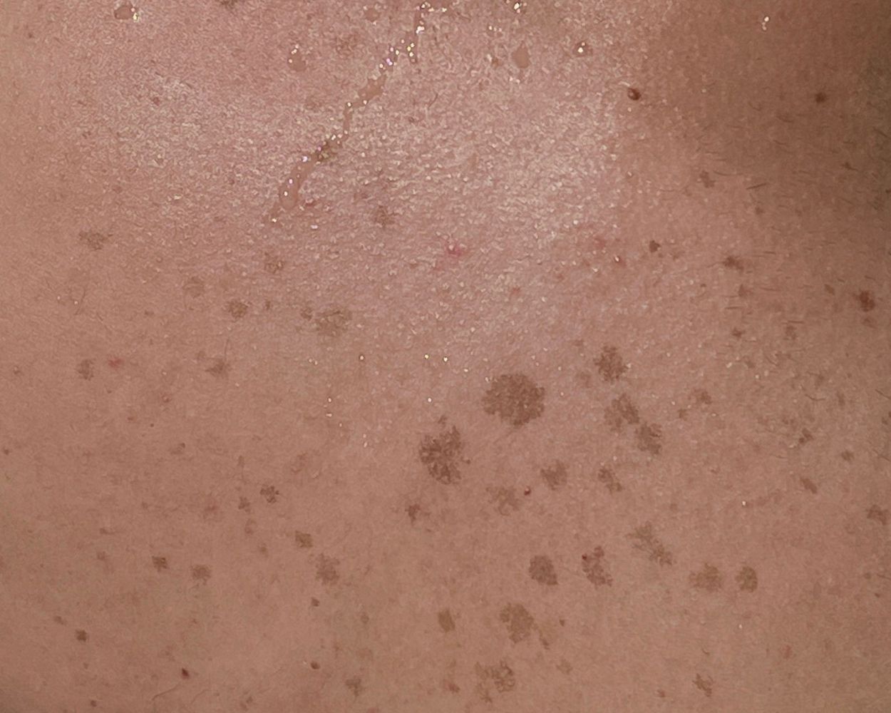 Age Spots On Face Causes & Natural Remedies To Remove Them