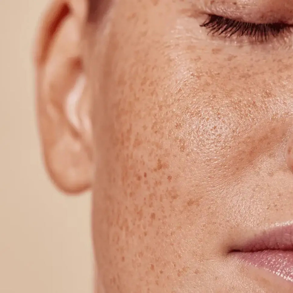 Age Spots On Face Causes & Natural Remedies To Remove Them