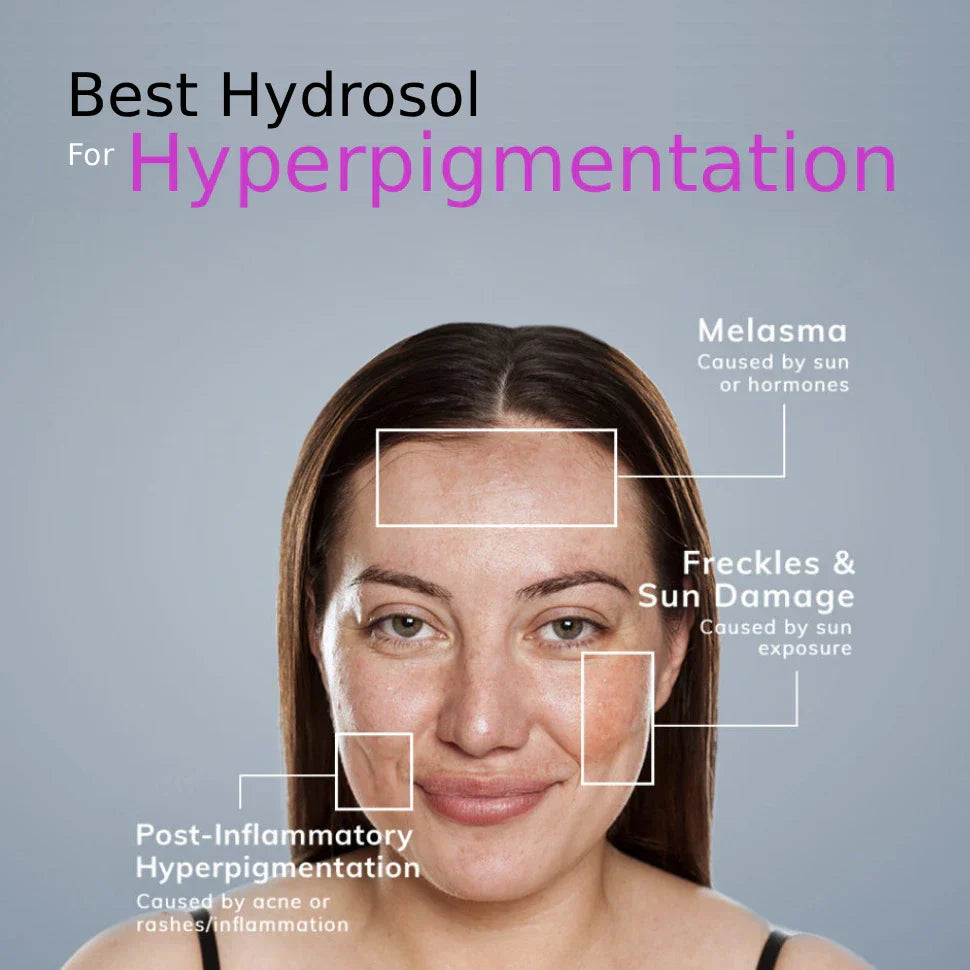 Best Hydrosol For Hyperpigmentation - Experts Recommendations