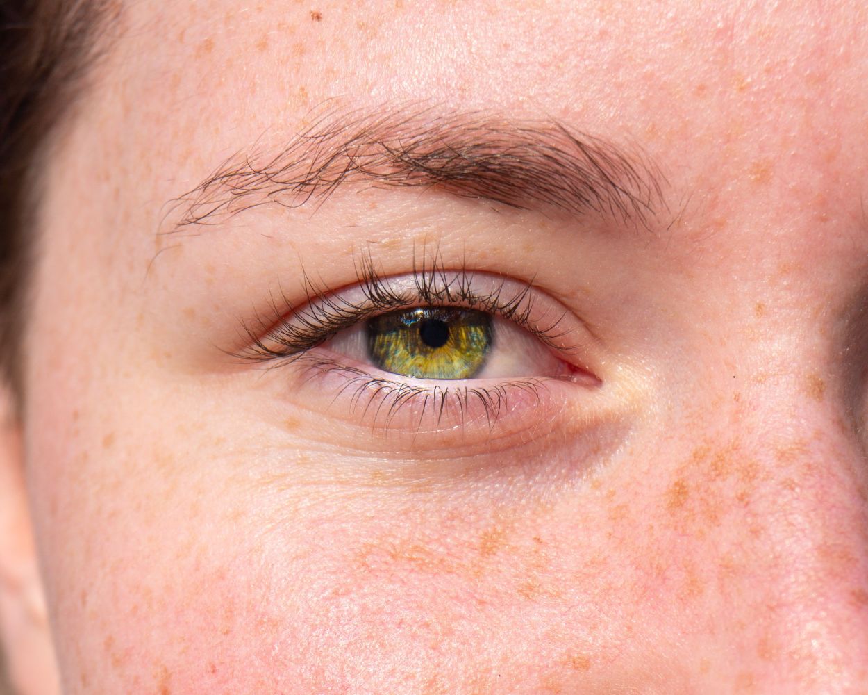 Best Hydrosol For Hyperpigmentation - Experts Recommendations